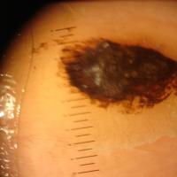 
	Dermoscopic appearance of figure 9

	Copied…