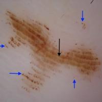 
	Dermoscopic appearance of figure…