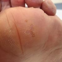 
	Same patient as figure 5
	
	The superficial…