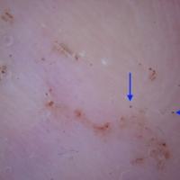 
	Dermoscopic appearance of figure 5 after…