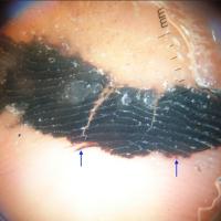 
	Dermoscopic appearance of figure 12
	
	Evidence…
