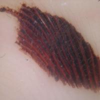 
	Dermoscopic appearance of figure 1
	
	A…