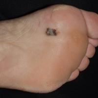 
	Acral-lentiginous melanoma

	This arose in an…