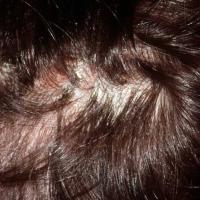 
	Tinea capitis with scale, no scaring