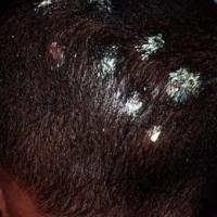 
	Tinea capitis with scale and early scaring