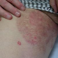
	Tinea cruris

	Treated with topical anti-fungals