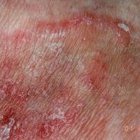 
	Tinea corporis, close up

	Copied with kind…