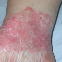 
	Tinea incognito