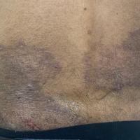 Tinea incognito
This also affected the buttocks,…