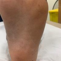 Same patient as previous image - tinea…