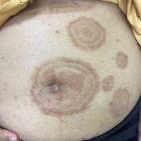 Tinea&nbsp;imbricata 
Copied with kind…