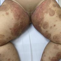 Tinea  imbricata - same patient as previous…
