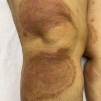 Tinea  imbricata  - same patient&nbsp;
Copied…