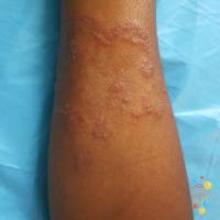 Tinea corporis&nbsp;
Copied with kind permission…
