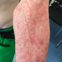 Tinea incognito
Copied with kind permission from…