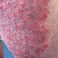 Tinea incognito
Copied with kind permission from…
