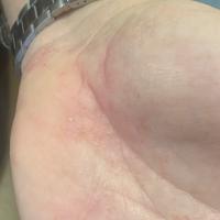 Same patient
Vesicles on the palms - part of the…