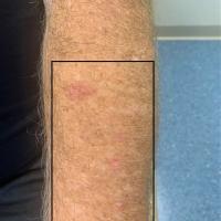 Same patient
Erythematous plaques - part of the…