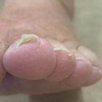 Same patient
Evidence of tinea unguium affecting…