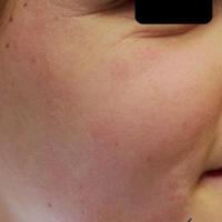 
	Tinea faciei

	Extensive and asymmetrical…