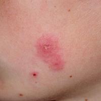 
	Tinea faciei

	Left cheek