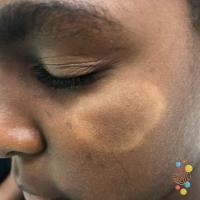 Tinea faciei&nbsp;
Copied with kind permission…