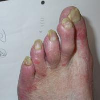 
	Tinea unguium

	Yellow, thickened nails