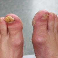 
	Tinea unguium