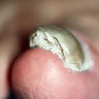 
	Tinea unguium

	Close up showing marked…