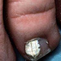 
	Superficial tinea unguium with whitening