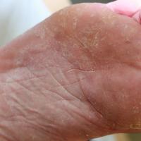 
	Tinea pedis

	Fine scaling, especially of the…