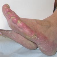 
	Tinea pedis

	Scale and well-defined erythema.…