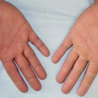 
	Tinea manuum

	Fine scaling of the palmar…
