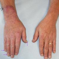 
	Tinea unguium of fingernails (purple…