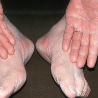 
	Two feet-one hand syndrome

	In the two…