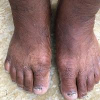 Tinea pedis