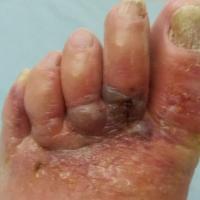 
	Bullous reaction secondary to tinea

	Image…