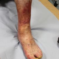
	Tinea unguium and recurrent cellulitis…