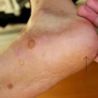 
	Tinea unguium with a bullous reaction

	Several…