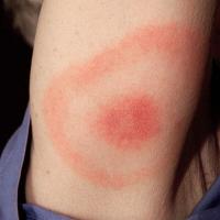 
	Lyme disease - erythema migrans