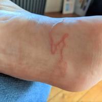 Cutaneous larva migrans
Copied with kind…