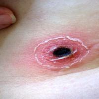 
	African tick-bite fever with an eschar