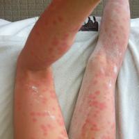 
	Acute schistosomiasis