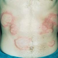 
	Acute schistosomiasis