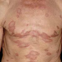 
	Borderline leprosy&nbsp;