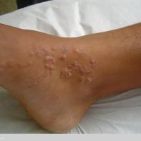 
	Cutaneous larva migrans