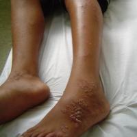 
	Cutaneous larva migrans