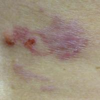 
	Cutaneous larva migrans