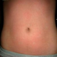 
	Dengue fever

	A faint macular rash containing…