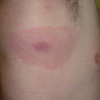 
	Lyme disease - erythema migrans